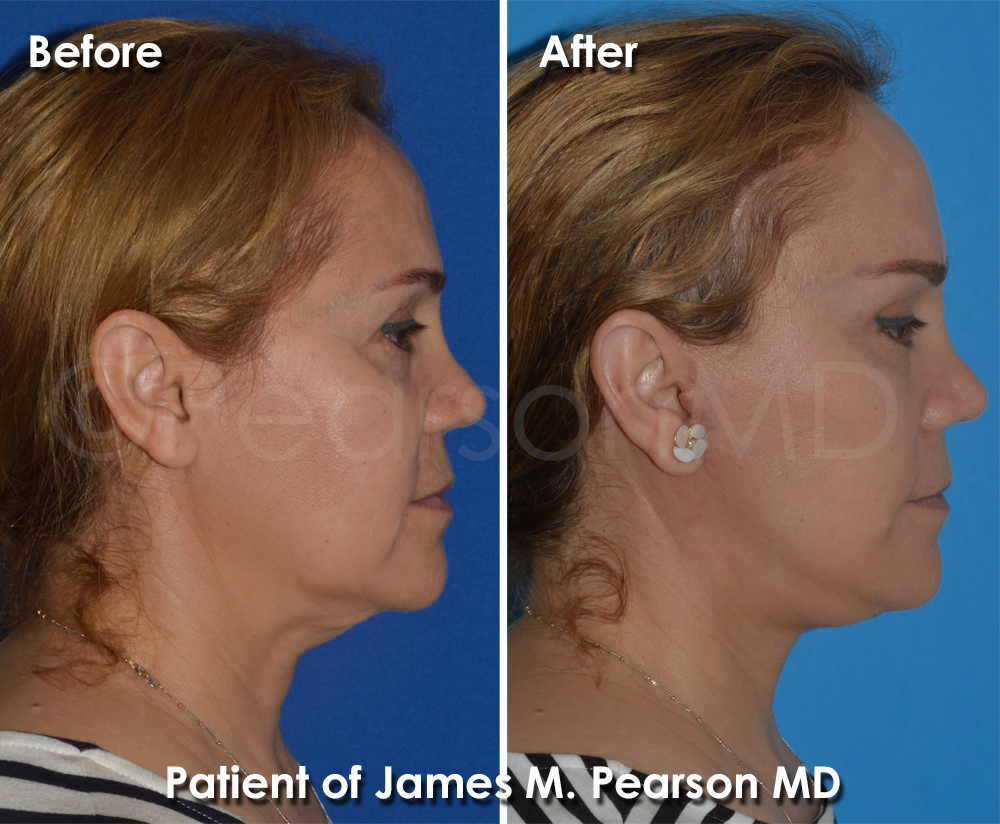 Pearson Plastic Surgery