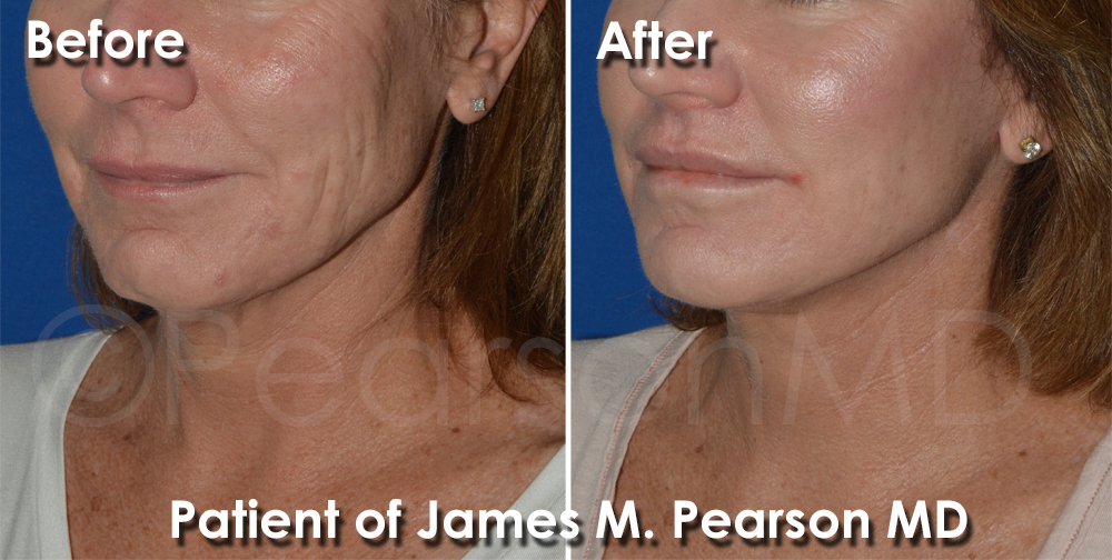 Redondo Beach Facelift