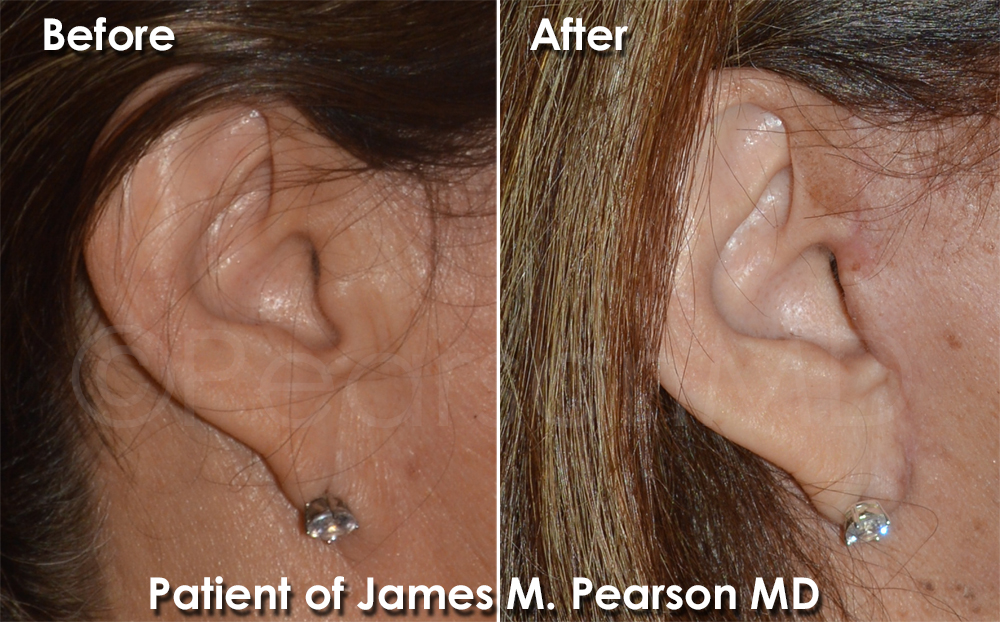 Photo Facelift Dr. James Pearson Facial Plastic Surgery Pearson Plastic Surgery
