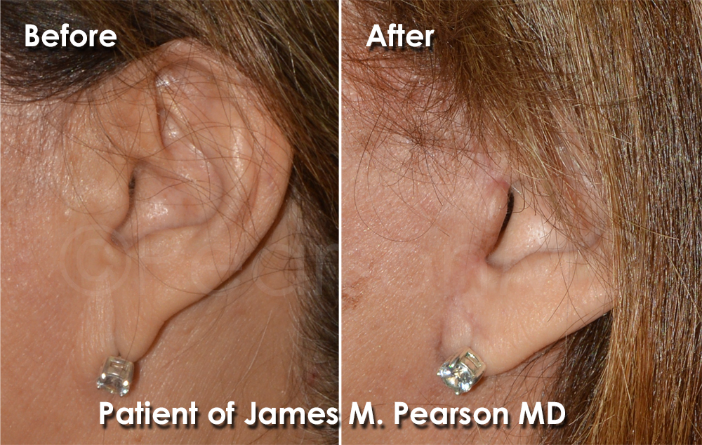 Photo Facelift Dr. James Pearson Facial Plastic Surgery Pearson Cosmetic Surgery