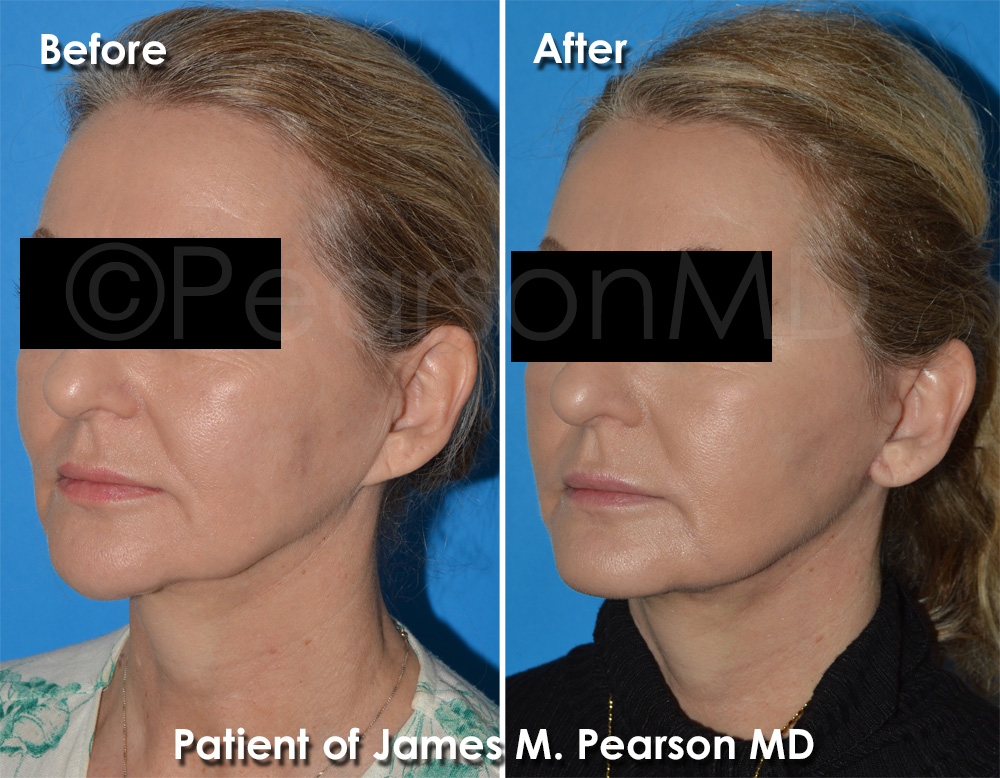 Facelift Hermosa Beach