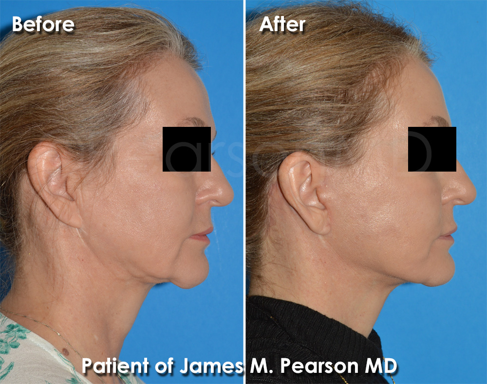 Facelift Manhattan Beach