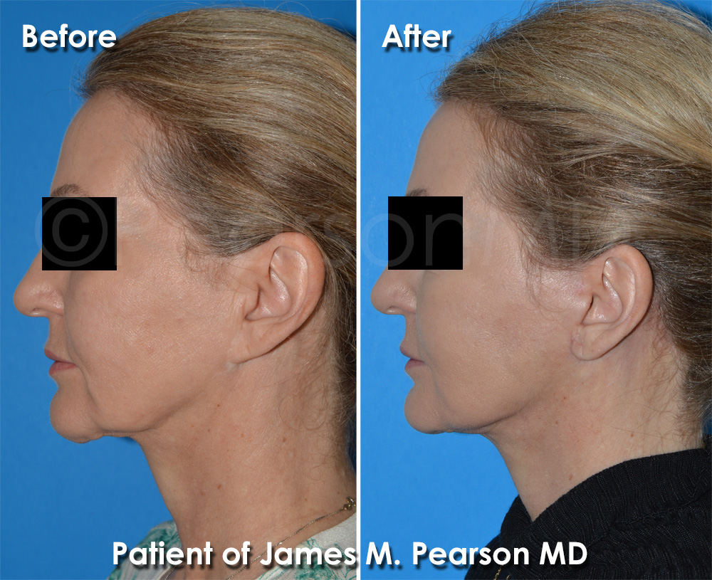 Facelift Redondo Beach