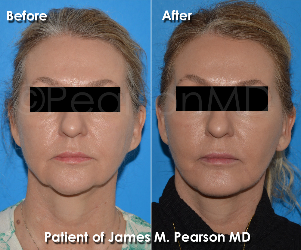 Facelift Torrance