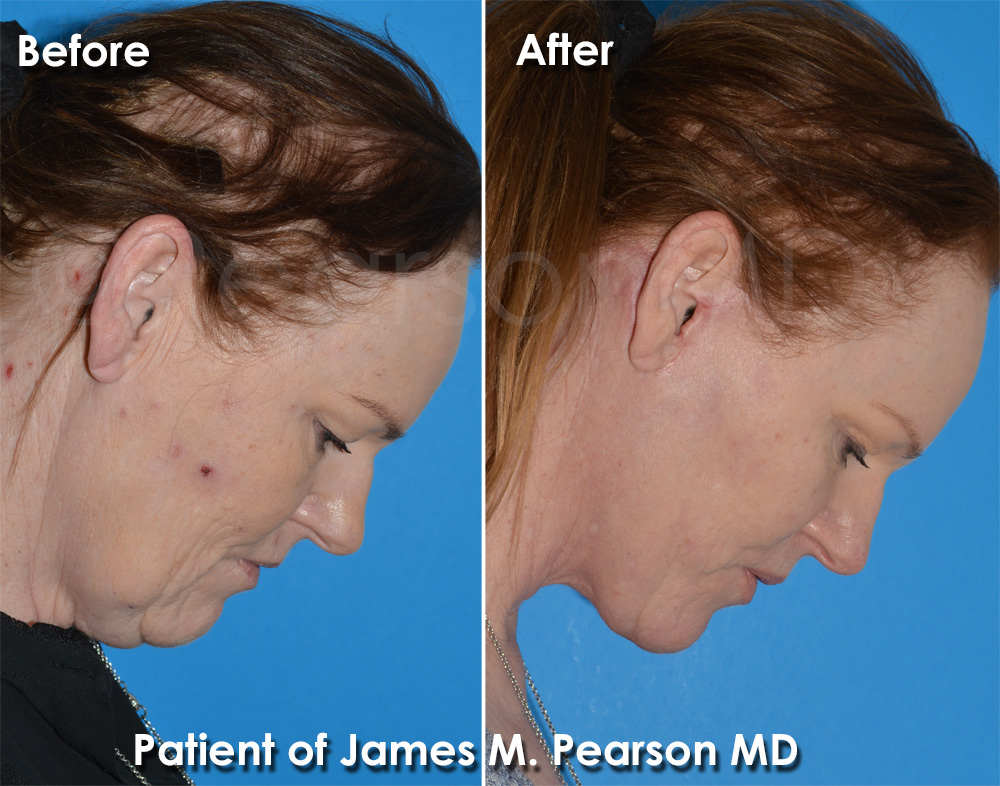Facelift Manhattan Beach
