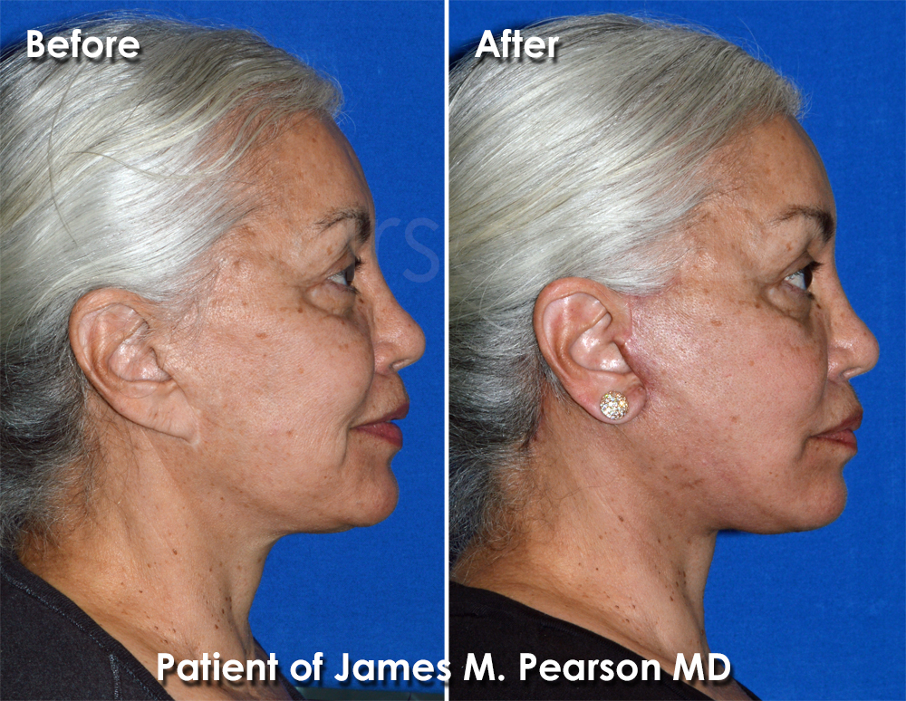 Dr. Pearson Plastic Surgeon