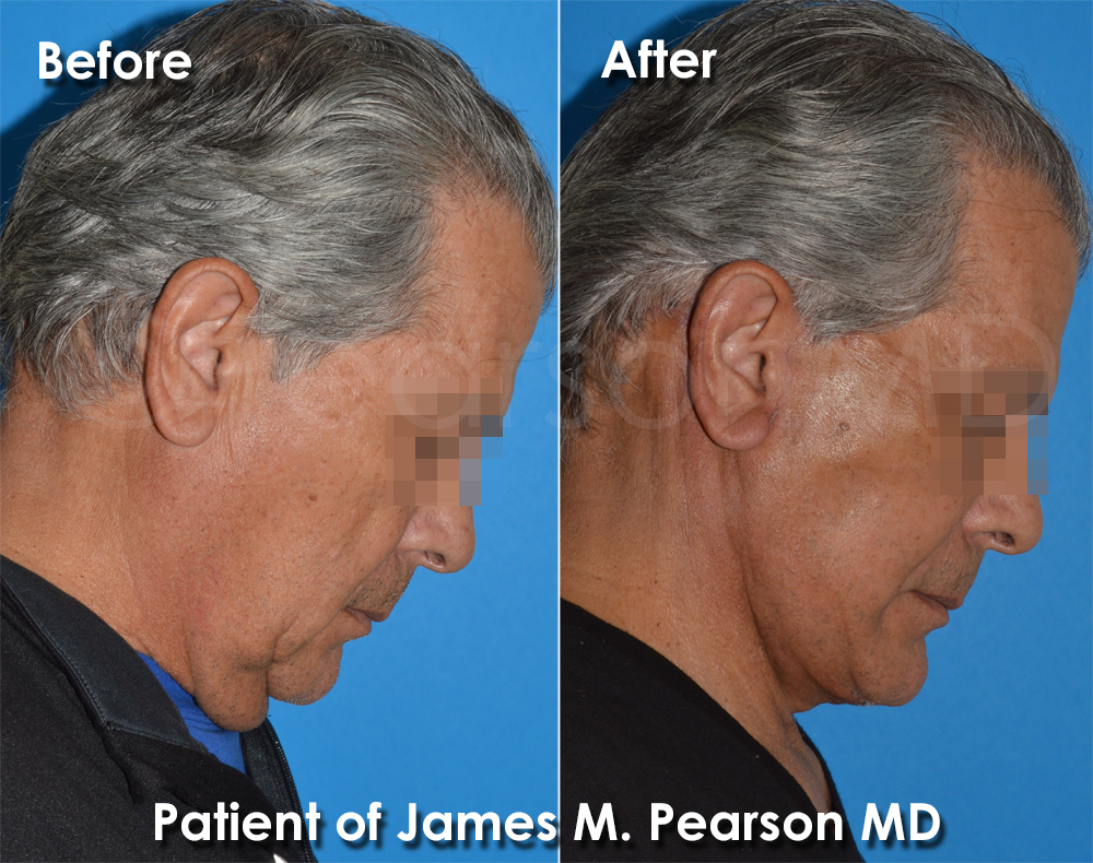Dr. Pearson Plastic Surgeon