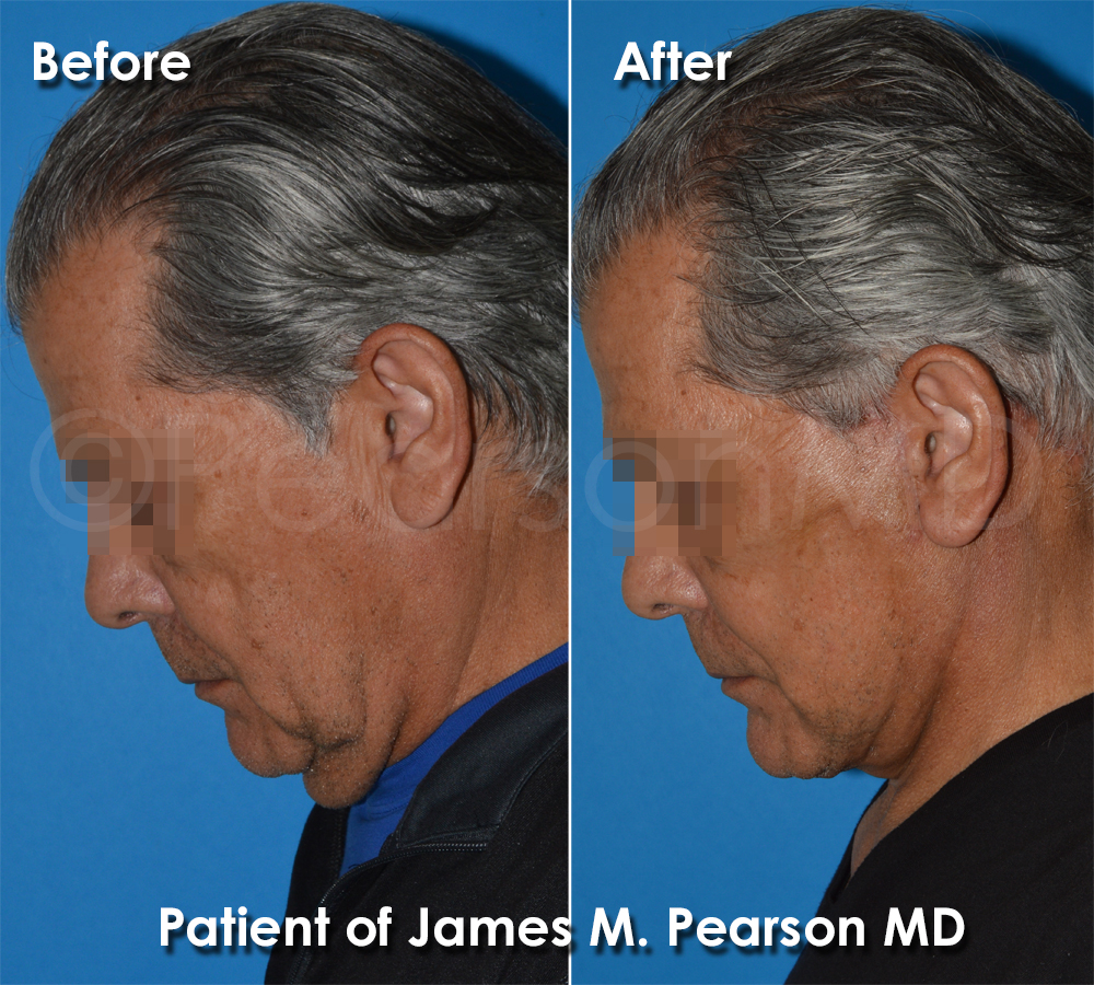 Facelift Hermosa Beach