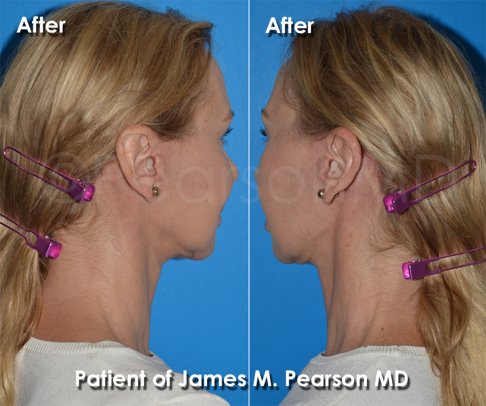 Neck Lift Incision Site