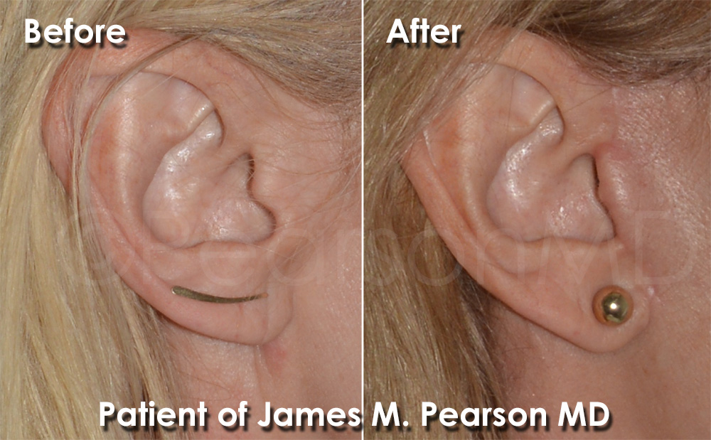 Photo Facelift Dr. James Pearson Facial Plastic Surgery Facelift Incision Site