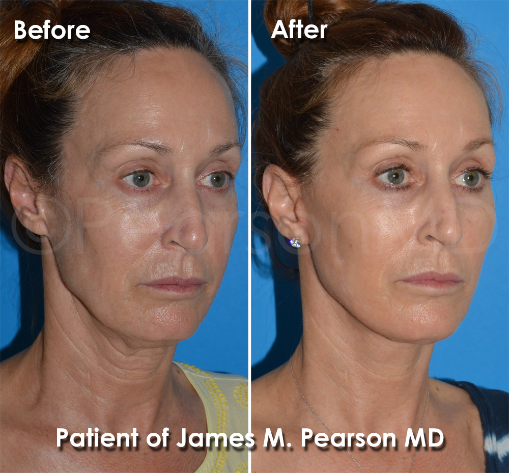 Facelift Manhattan Beach