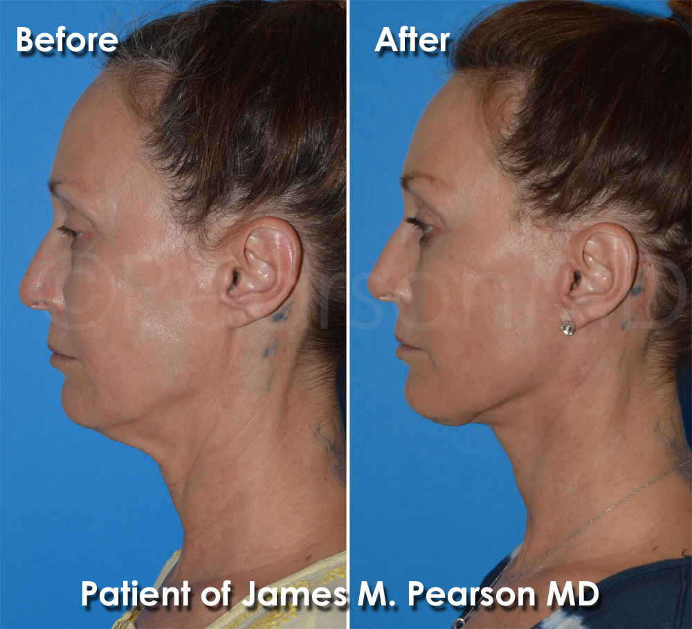 Facelift Redondo Beach