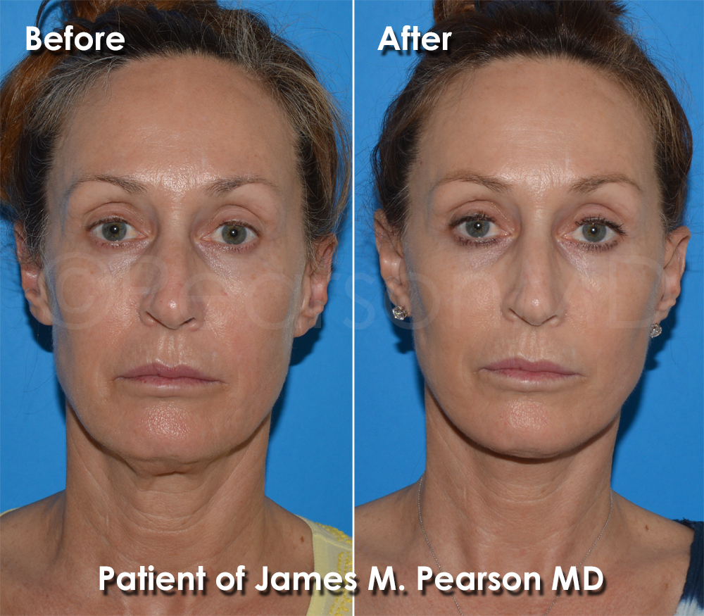 Pearson Plastic Surgery