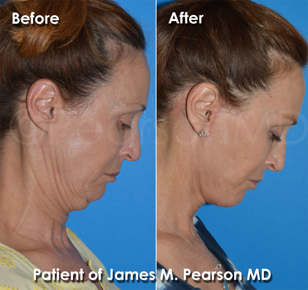 Pearson Cosmetic Surgery