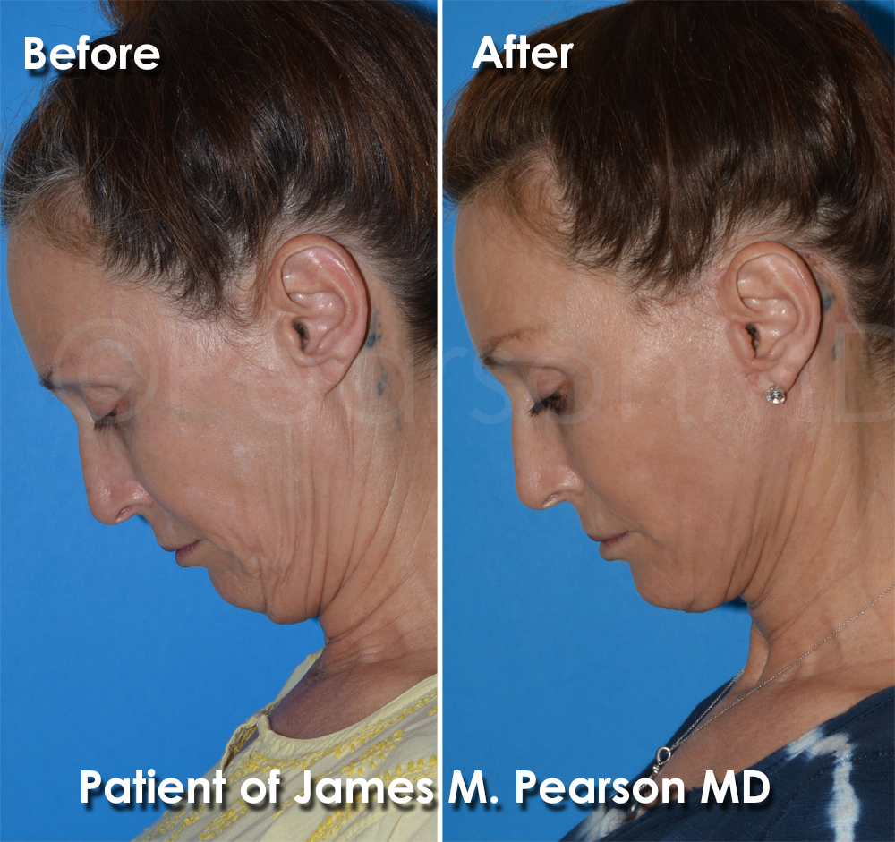 Dr. Pearson Plastic Surgery