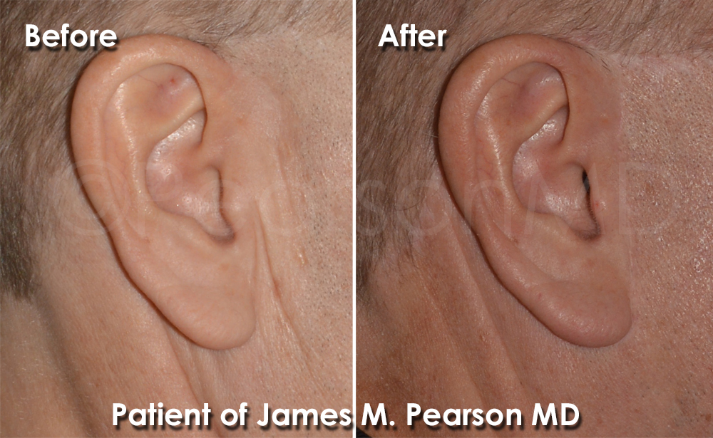 Facelift for Men Los Angeles