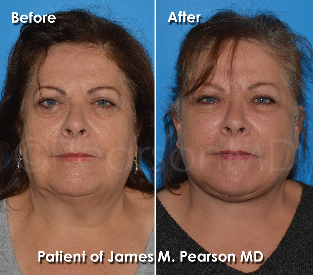 Facelift Redondo Beach