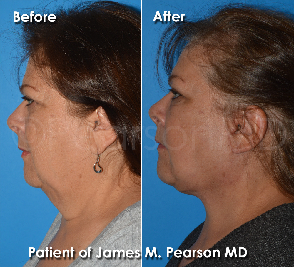 Facelift Seal Beach