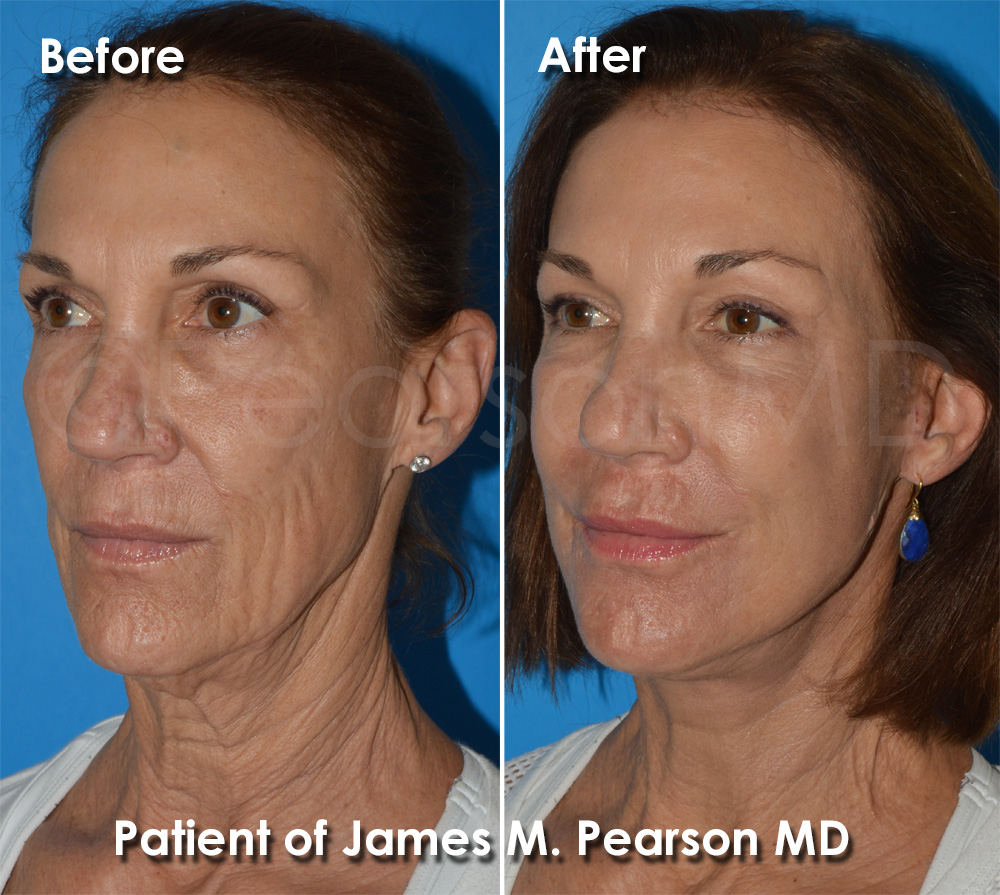 Pearson Cosmetic Surgery