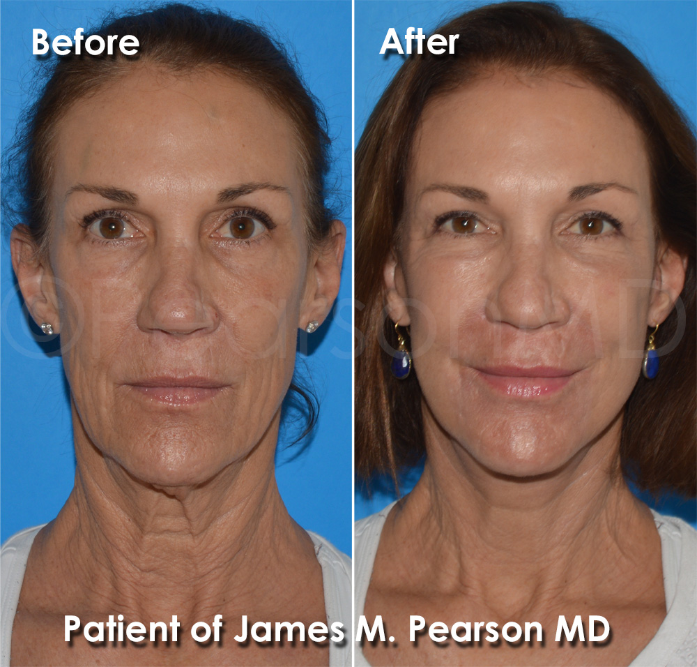 Dr. Pearson Plastic Surgery