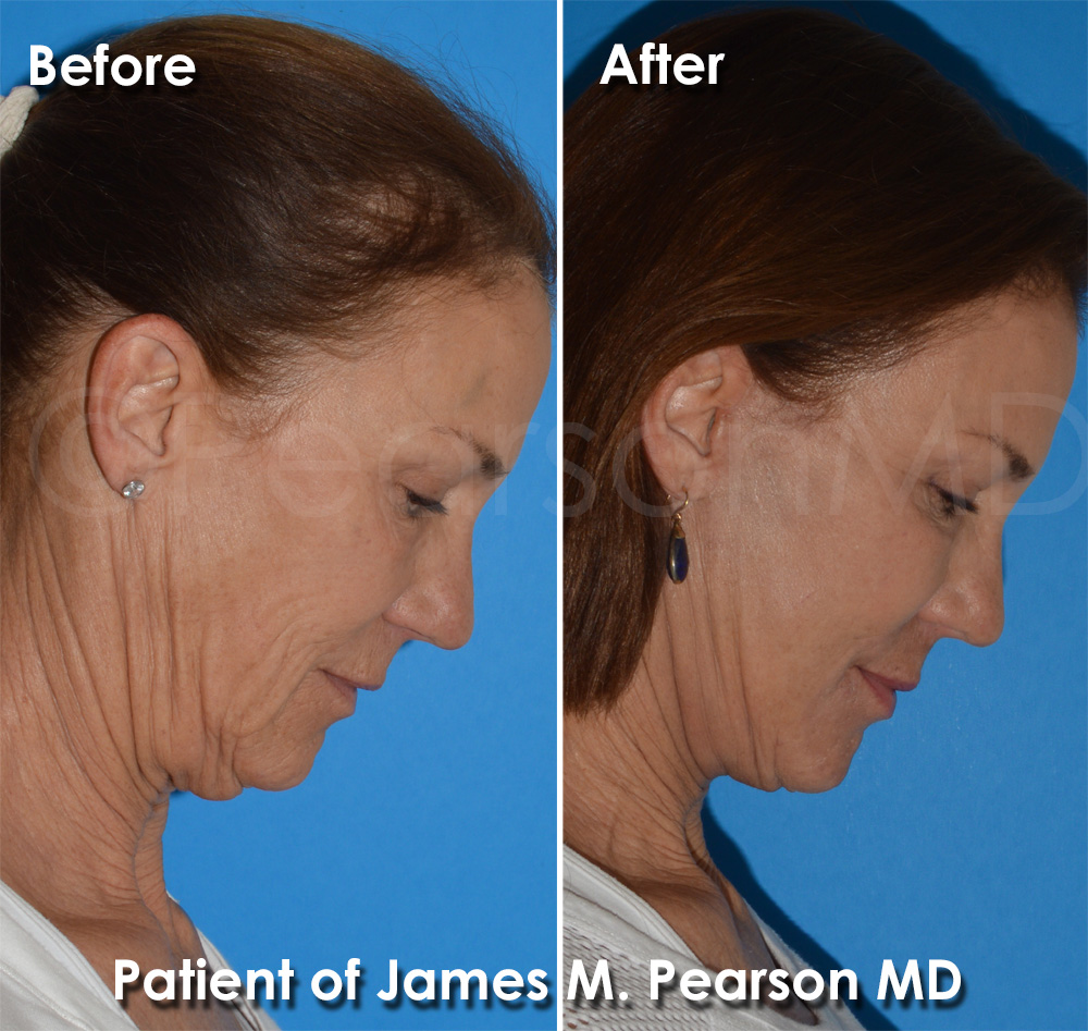 Facelift Hermosa Beach