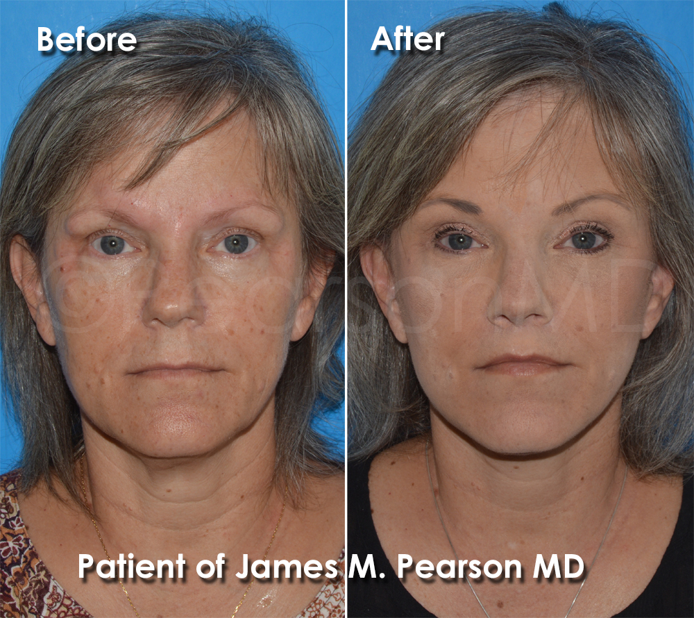 Pearson Cosmetic Surgery