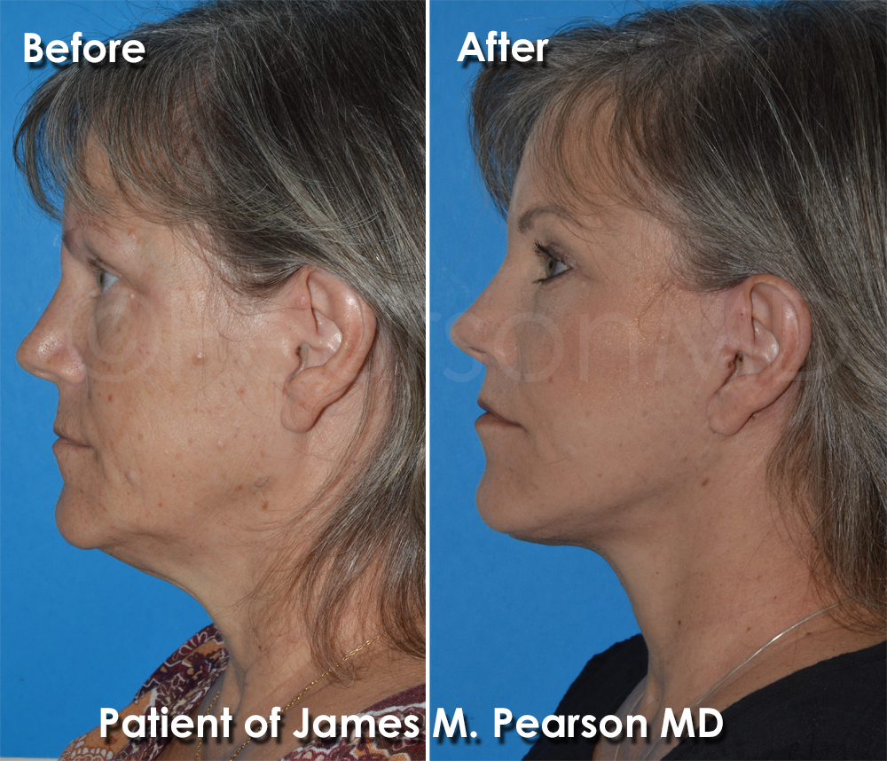 Pearson Facelift