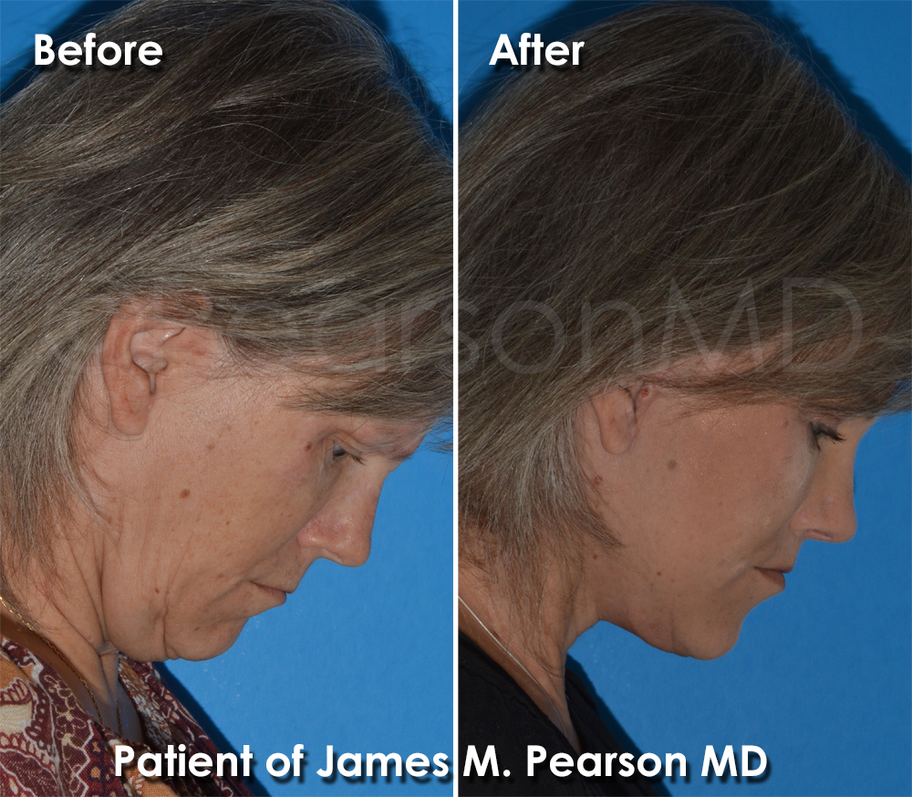 Pearson Plastic Surgery