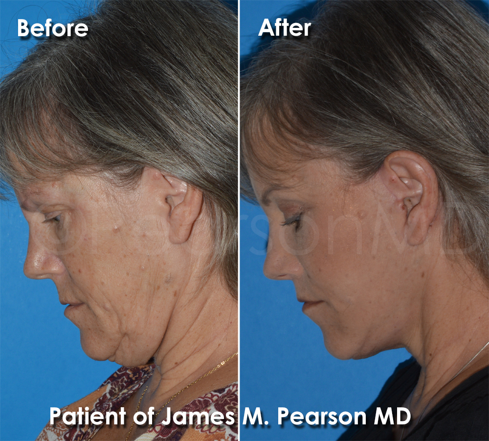 Pearson Cosmetic Surgery
