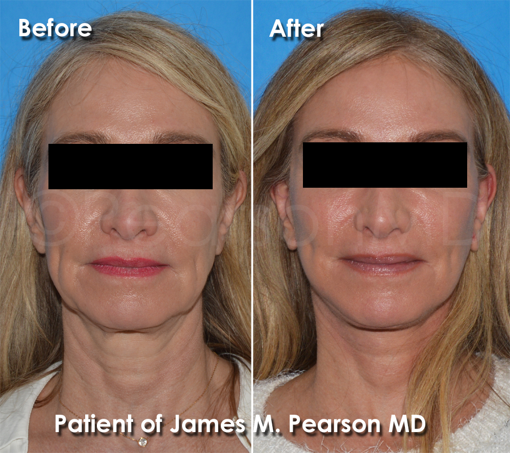 Facelift Dr. Pearson
