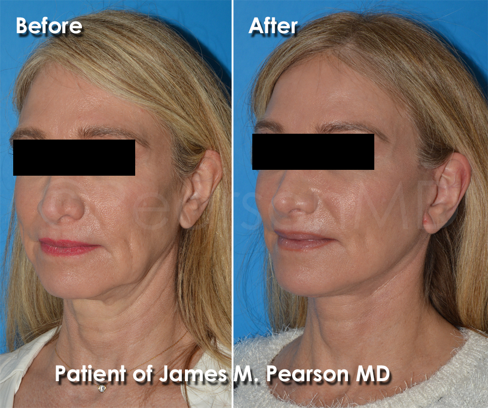 Pearson Plastic Surgery