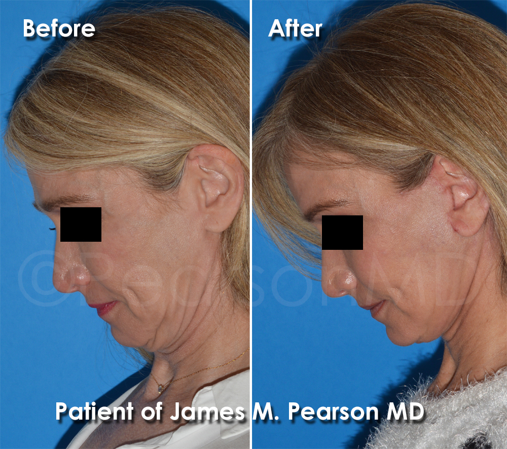 Pearson Plastic Surgery