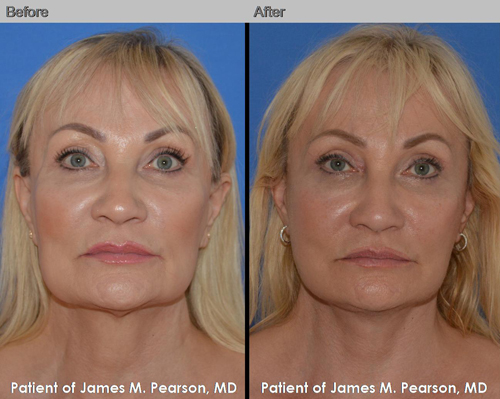 Dr. Pearson Revision Facelift and Neck Lift Photos Pearson Revision Facelift Photos