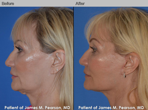 Dr. Pearson Revision Facelift and Neck Lift Photos Pearson Revision Facelift Photos