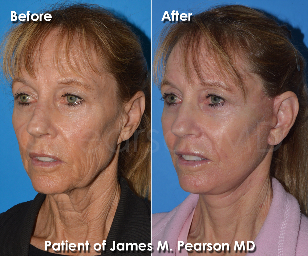 Pearson Cosmetic Surgery
