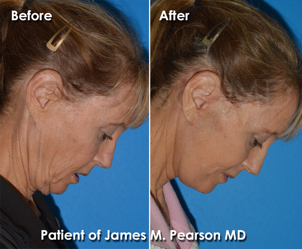 Pearson Plastic Surgery