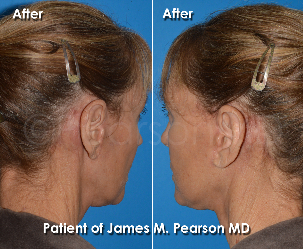 Dr. Pearson Facelift Scar Neck