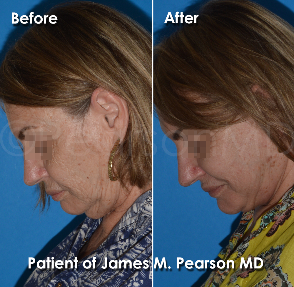 Pearson Facelift