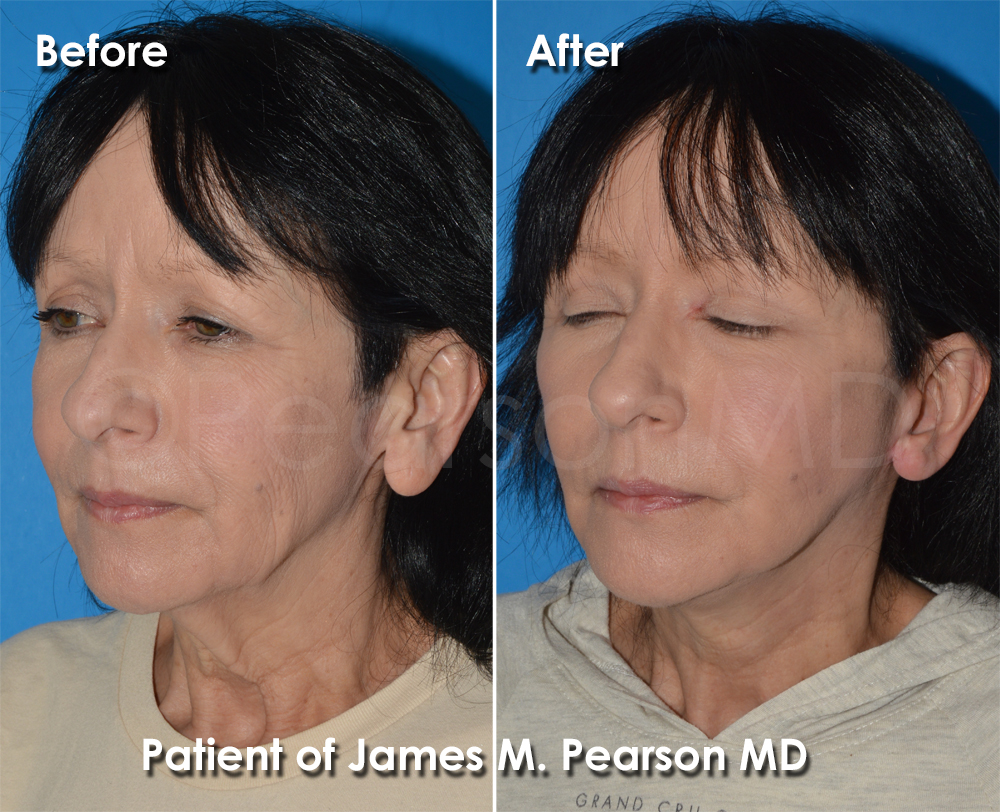Dr. Pearson Facelift