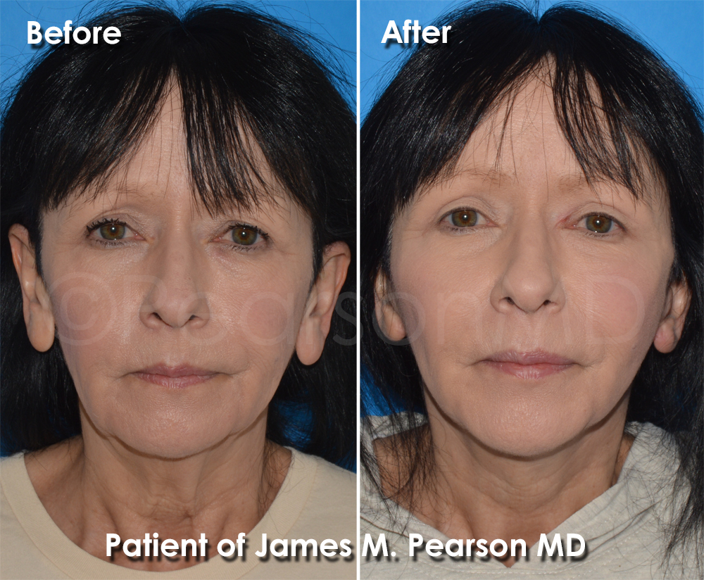 Pearson Plastic Surgery