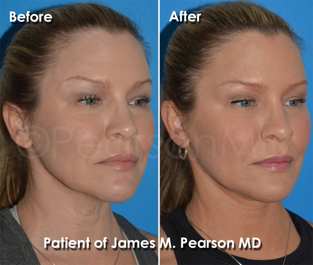 Pearson Plastic Surgery