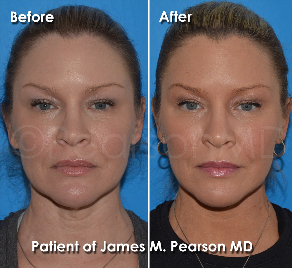 Pearson Facial Surgery