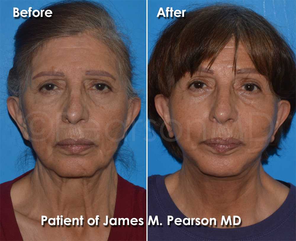Pearson Plastic Surgery