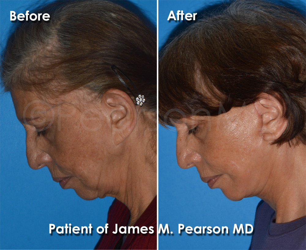 Dr. Pearson Plastic Surgeon