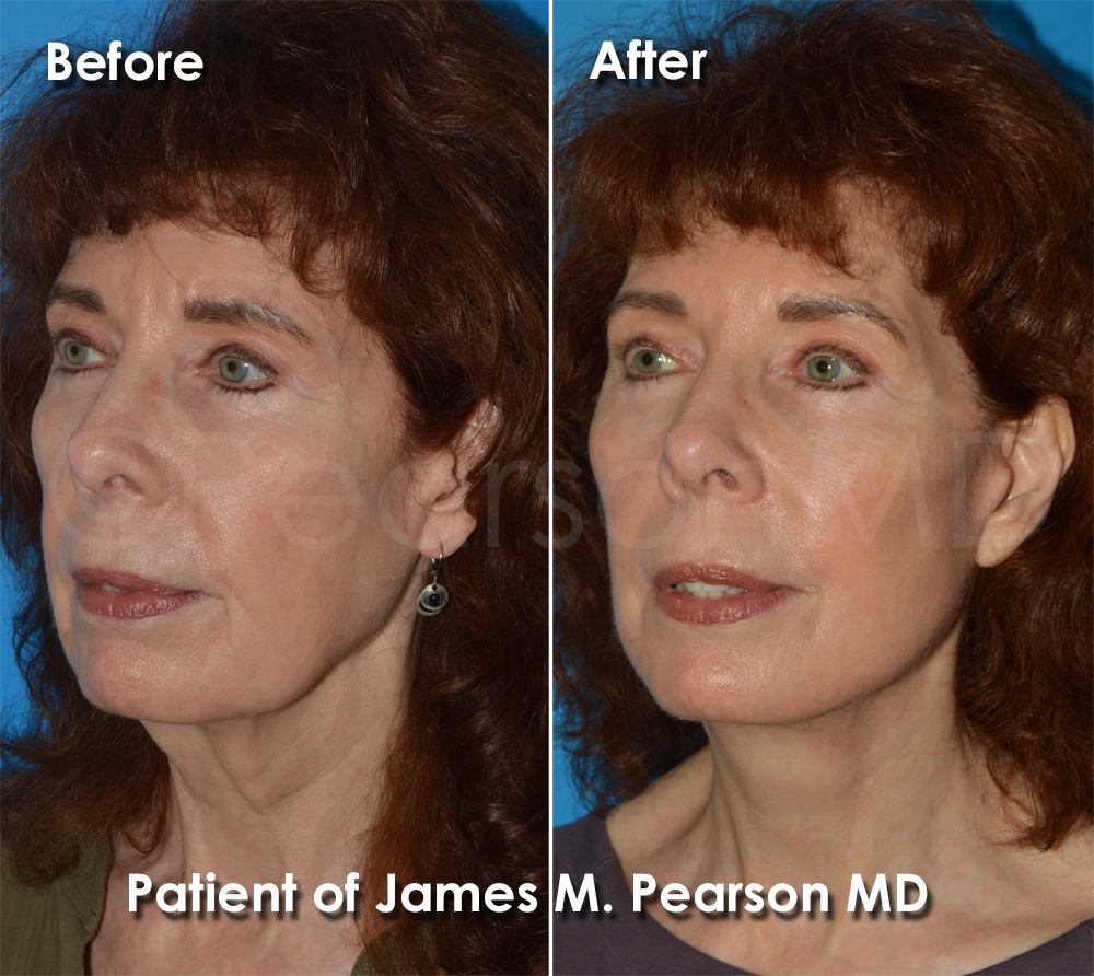Dr. Pearson Facelift