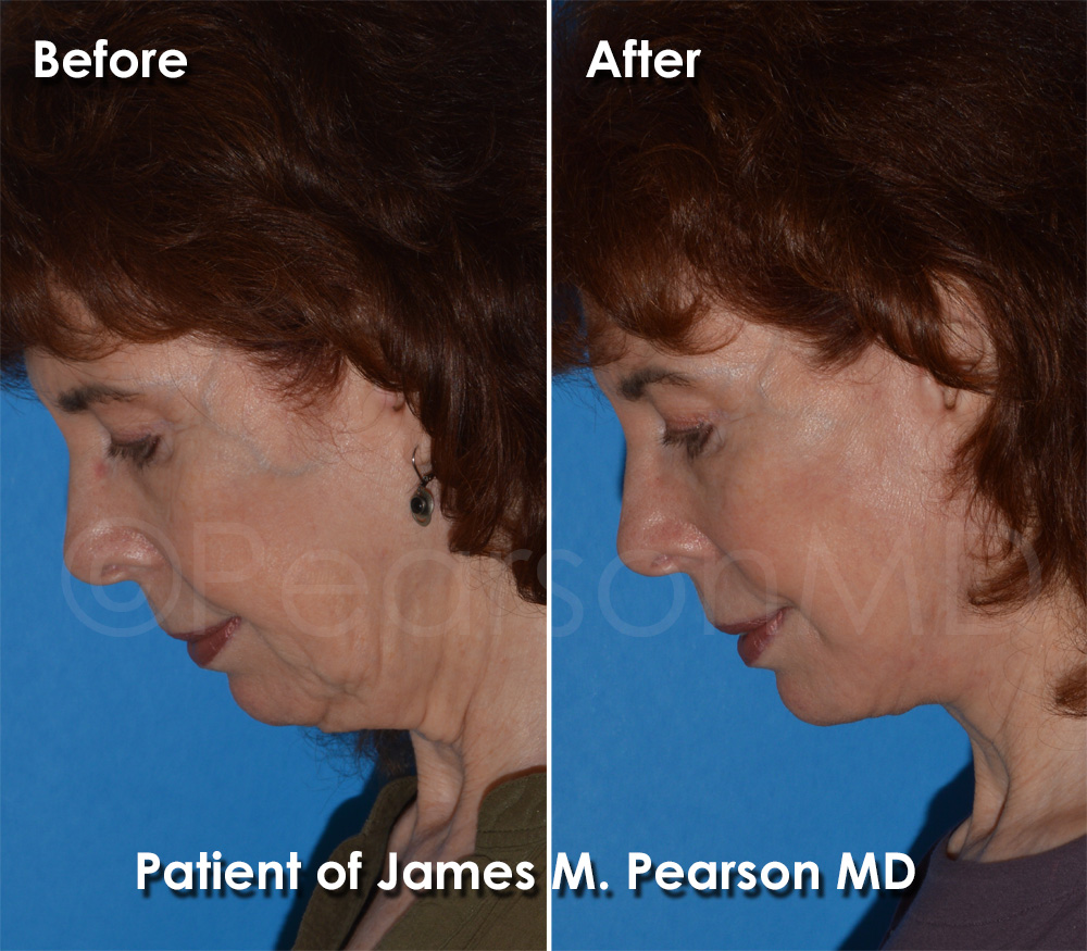 Pearson Plastic Surgery