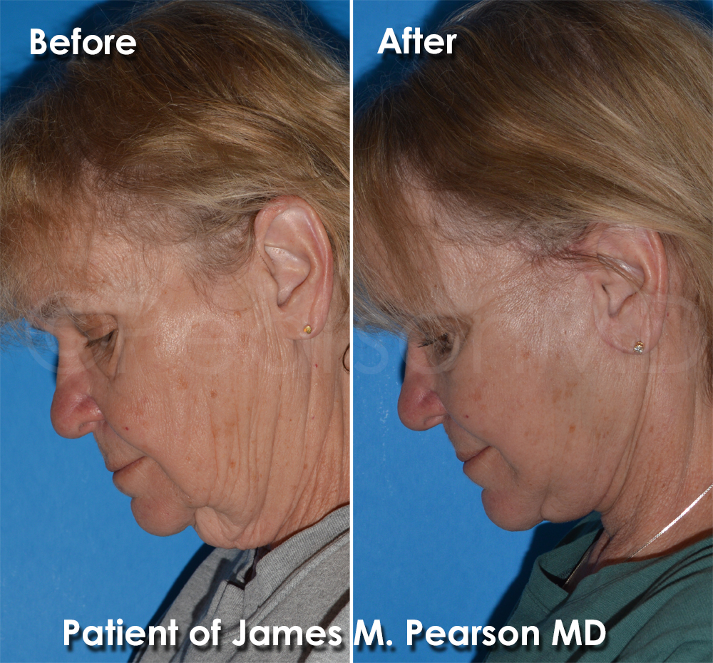 Dr. Pearson Facelift Surgery