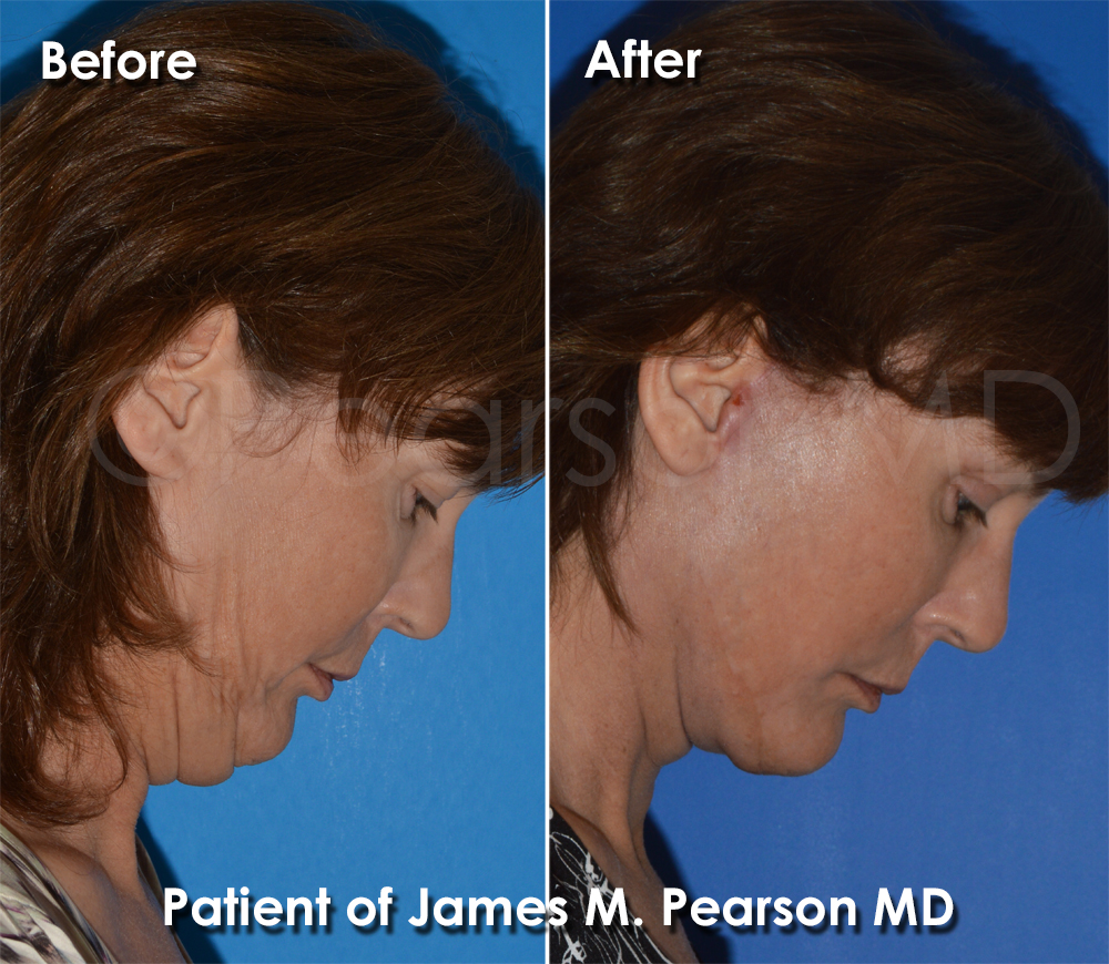 Dr. Pearson Facelift