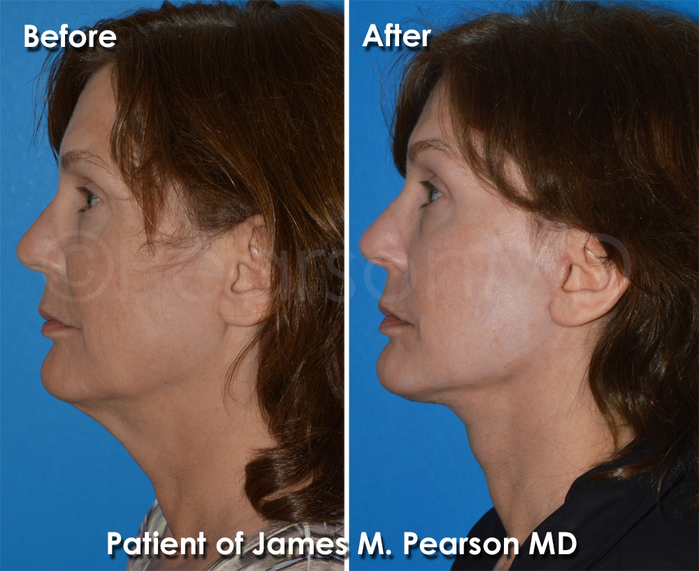 Pearson Plastic Surgery