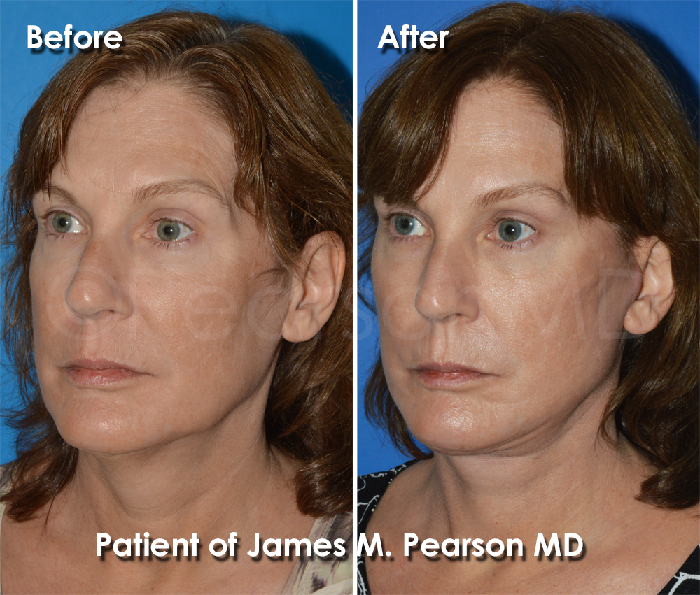 Dr. Pearson Facelift Surgery